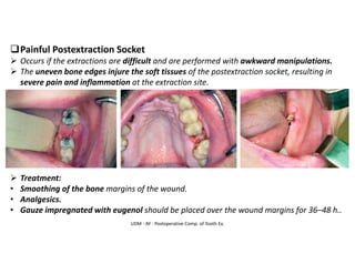 UDM - AY - Postoperative Comp. of Tooth Ex.
❑Painful Postextraction Socket
➢ Occurs if the extractions are difficult and are performed with awkward manipulations.
➢ The uneven bone edges injure the soft tissues of the postextraction socket, resulting in
severe pain and inflammation at the extraction site.
➢ Treatment:
• Smoothing of the bone margins of the wound.
• Analgesics.
• Gauze impregnated with eugenol should be placed over the wound margins for 36–48 h..
 