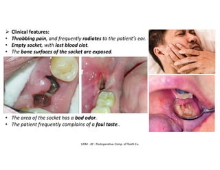 UDM - AY - Postoperative Comp. of Tooth Ex.
➢ Clinical features:
• Throbbing pain, and frequently radiates to the patient’s ear.
• Empty socket, with lost blood clot.
• The bone surfaces of the socket are exposed.
• The area of the socket has a bad odor.
• The patient frequently complains of a foul taste..
 