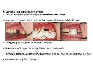 III. Control of Post-extraction Hemorrhage
➢ Place a small piece of moistened gauze directly over the socket.
➢ Large packs that cover the occlusal surfaces of the adjacent teeth is ineffective!
➢ Biting firmly on this gauze for at least 30 minutes.
➢ Ooze is normal for up to 24 hours after the extraction procedure.
➢ With more bleeding, reapplying the gauze for as long as 1 hour to gain control of bleeding.
➢ Biting on a tea bag for 30 minutes..
 