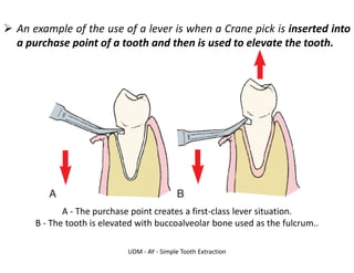 UDM - AY - Simple Tooth Extraction
➢ An example of the use of a lever is when a Crane pick is inserted into
a purchase point of a tooth and then is used to elevate the tooth.
A - The purchase point creates a first-class lever situation.
B - The tooth is elevated with buccoalveolar bone used as the fulcrum..
 