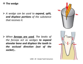 UDM - AY - Simple Tooth Extraction
❖ The wedge
➢ A wedge can be used to expand, split,
and displace portions of the substance
that receives it.
➢ When forceps are used, The beaks of
the forceps act as wedges to expand
alveolar bone and displace the tooth in
the occlusal direction (out of the
socket)..
 