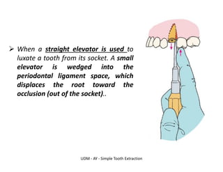 UDM - AY - Simple Tooth Extraction
➢ When a straight elevator is used to
luxate a tooth from its socket. A small
elevator is wedged into the
periodontal ligament space, which
displaces the root toward the
occlusion (out of the socket)..
 