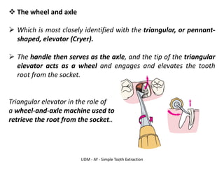 UDM - AY - Simple Tooth Extraction
❖ The wheel and axle
➢ Which is most closely identified with the triangular, or pennant-
shaped, elevator (Cryer).
➢ The handle then serves as the axle, and the tip of the triangular
elevator acts as a wheel and engages and elevates the tooth
root from the socket.
Triangular elevator in the role of
a wheel-and-axle machine used to
retrieve the root from the socket..
 