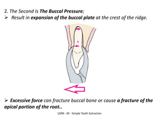 UDM - AY - Simple Tooth Extraction
2. The Second Is The Buccal Pressure;
➢ Result in expansion of the buccal plate at the crest of the ridge.
➢ Excessive force can fracture buccal bone or cause a fracture of the
apical portion of the root..
 