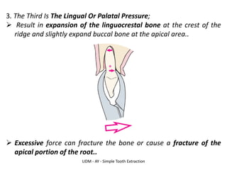 UDM - AY - Simple Tooth Extraction
3. The Third Is The Lingual Or Palatal Pressure;
➢ Result in expansion of the linguocrestal bone at the crest of the
ridge and slightly expand buccal bone at the apical area..
➢ Excessive force can fracture the bone or cause a fracture of the
apical portion of the root..
 