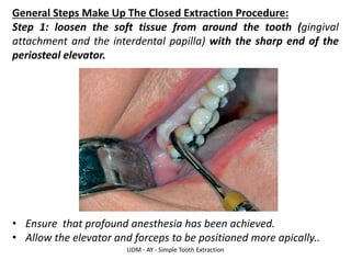 UDM - AY - Simple Tooth Extraction
General Steps Make Up The Closed Extraction Procedure:
Step 1: loosen the soft tissue from around the tooth (gingival
attachment and the interdental papilla) with the sharp end of the
periosteal elevator.
• Ensure that profound anesthesia has been achieved.
• Allow the elevator and forceps to be positioned more apically..
 