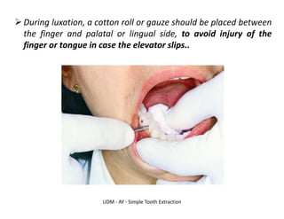 UDM - AY - Simple Tooth Extraction
➢During luxation, a cotton roll or gauze should be placed between
the finger and palatal or lingual side, to avoid injury of the
finger or tongue in case the elevator slips..
 