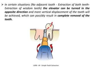 UDM - AY - Simple Tooth Extraction
➢ In certain situations (No adjacent tooth - Extraction of both teeth-
Extraction of wisdom teeth) the elevator can be turned in the
opposite direction and more vertical displacement of the tooth will
be achieved, which can possibly result in complete removal of the
tooth.
 
