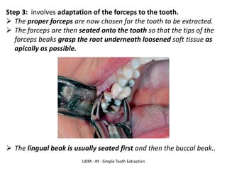UDM - AY - Simple Tooth Extraction
Step 3: involves adaptation of the forceps to the tooth.
➢ The proper forceps are now chosen for the tooth to be extracted.
➢ The forceps are then seated onto the tooth so that the tips of the
forceps beaks grasp the root underneath loosened soft tissue as
apically as possible.
➢ The lingual beak is usually seated first and then the buccal beak..
 