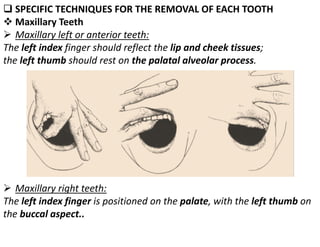❑ SPECIFIC TECHNIQUES FOR THE REMOVAL OF EACH TOOTH
❖ Maxillary Teeth
➢ Maxillary left or anterior teeth:
The left index finger should reflect the lip and cheek tissues;
the left thumb should rest on the palatal alveolar process.
➢ Maxillary right teeth:
The left index finger is positioned on the palate, with the left thumb on
the buccal aspect..
 
