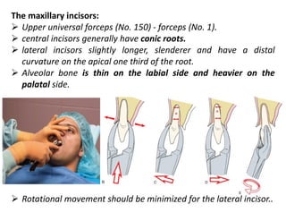 The maxillary incisors:
➢ Upper universal forceps (No. 150) - forceps (No. 1).
➢ central incisors generally have conic roots.
➢ lateral incisors slightly longer, slenderer and have a distal
curvature on the apical one third of the root.
➢ Alveolar bone is thin on the labial side and heavier on the
palatal side.
➢ Rotational movement should be minimized for the lateral incisor..
 