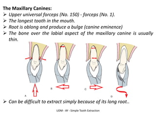 UDM - AY - Simple Tooth Extraction
The Maxillary Canines:
➢ Upper universal forceps (No. 150) - forceps (No. 1).
➢ The longest tooth in the mouth.
➢ Root is oblong and produce a bulge (canine eminence)
➢ The bone over the labial aspect of the maxillary canine is usually
thin.
➢ Can be difficult to extract simply because of its long root..
 