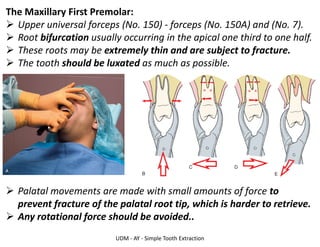 UDM - AY - Simple Tooth Extraction
The Maxillary First Premolar:
➢ Upper universal forceps (No. 150) - forceps (No. 150A) and (No. 7).
➢ Root bifurcation usually occurring in the apical one third to one half.
➢ These roots may be extremely thin and are subject to fracture.
➢ The tooth should be luxated as much as possible.
➢ Palatal movements are made with small amounts of force to
prevent fracture of the palatal root tip, which is harder to retrieve.
➢ Any rotational force should be avoided..
 