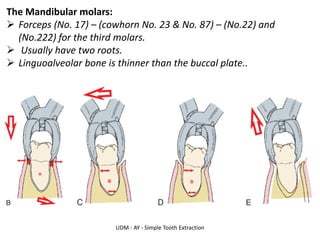 UDM - AY - Simple Tooth Extraction
The Mandibular molars:
➢ Forceps (No. 17) – (cowhorn No. 23 & No. 87) – (No.22) and
(No.222) for the third molars.
➢ Usually have two roots.
➢ Linguoalveolar bone is thinner than the buccal plate..
 
