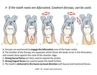 UDM - AY - Simple Tooth Extraction
➢ If the tooth roots are bifurcated, Cowhorn forceps, can be used.
A, Forceps are positioned to engage the bifurcation area of the lower molar.
B, The handles of the forceps are squeezed, which forces the beaks to be in the bifurcation,
and creates force against the crest of the alveolar ridge.
C, Strong buccal forces are then used to expand the socket.
D, Strong lingual forces are used to luxate the tooth further.
E, The tooth is delivered in the bucco-occlusal direction with buccal and tractional forces..
 