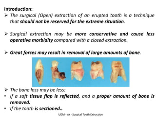 UDM - AY - Surgical Tooth Extraction
Introduction:
➢ The surgical (Open) extraction of an erupted tooth is a technique
that should not be reserved for the extreme situation.
➢ Surgical extraction may be more conservative and cause less
operative morbidity compared with a closed extraction.
➢ Great forces may result in removal of large amounts of bone.
➢ The bone loss may be less:
• If a soft tissue flap is reflected, and a proper amount of bone is
removed.
• If the tooth is sectioned..
 
