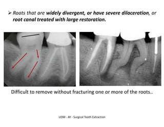 UDM - AY - Surgical Tooth Extraction
➢Roots that are widely divergent, or have severe dilaceration, or
root canal treated with large restoration.
Difficult to remove without fracturing one or more of the roots..
 