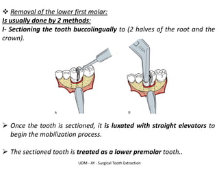 UDM - AY - Surgical Tooth Extraction
❖ Removal of the lower first molar:
Is usually done by 2 methods:
I- Sectioning the tooth buccolingually to (2 halves of the root and the
crown).
➢ Once the tooth is sectioned, it is luxated with straight elevators to
begin the mobilization process.
➢ The sectioned tooth is treated as a lower premolar tooth..
 