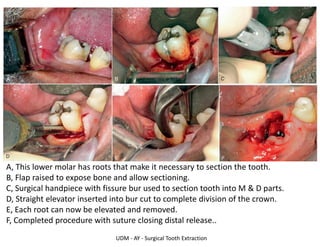 UDM - AY - Surgical Tooth Extraction
A, This lower molar has roots that make it necessary to section the tooth.
B, Flap raised to expose bone and allow sectioning.
C, Surgical handpiece with fissure bur used to section tooth into M & D parts.
D, Straight elevator inserted into bur cut to complete division of the crown.
E, Each root can now be elevated and removed.
F, Completed procedure with suture closing distal release..
 