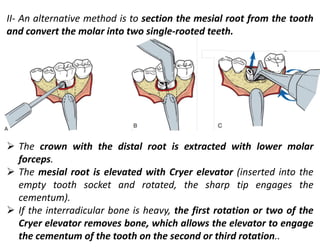 II- An alternative method is to section the mesial root from the tooth
and convert the molar into two single-rooted teeth.
➢ The crown with the distal root is extracted with lower molar
forceps.
➢ The mesial root is elevated with Cryer elevator (inserted into the
empty tooth socket and rotated, the sharp tip engages the
cementum).
➢ If the interradicular bone is heavy, the first rotation or two of the
Cryer elevator removes bone, which allows the elevator to engage
the cementum of the tooth on the second or third rotation..
 