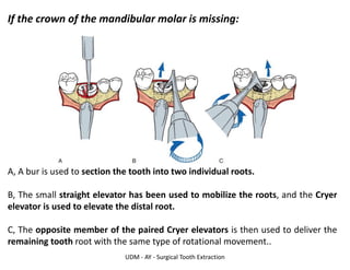 UDM - AY - Surgical Tooth Extraction
If the crown of the mandibular molar is missing:
A, A bur is used to section the tooth into two individual roots.
B, The small straight elevator has been used to mobilize the roots, and the Cryer
elevator is used to elevate the distal root.
C, The opposite member of the paired Cryer elevators is then used to deliver the
remaining tooth root with the same type of rotational movement..
 
