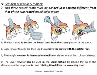 UDM - AY - Surgical Tooth Extraction
❖ Removal of maxillary molars:
➢ This three-rooted tooth must be divided in a pattern different from
that of the two rooted mandibular molar.
A, The bur is used to section the buccal roots from the crown portion of the tooth.
B, Upper molar forceps are then used to remove the crown with the palatal root.
C, The straight elevator is then used to mobilize or deliver one or both of buccal roots.
D, The Cryer elevator can be used in the usual fashion by placing the tip of the
elevator into the empty socket and rotating it to deliver the remaining root..
 