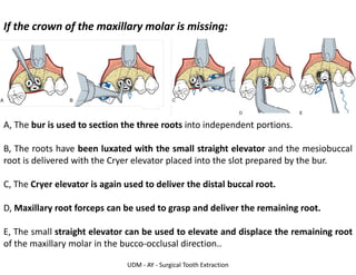 UDM - AY - Surgical Tooth Extraction
If the crown of the maxillary molar is missing:
A, The bur is used to section the three roots into independent portions.
B, The roots have been luxated with the small straight elevator and the mesiobuccal
root is delivered with the Cryer elevator placed into the slot prepared by the bur.
C, The Cryer elevator is again used to deliver the distal buccal root.
D, Maxillary root forceps can be used to grasp and deliver the remaining root.
E, The small straight elevator can be used to elevate and displace the remaining root
of the maxillary molar in the bucco-occlusal direction..
 