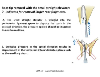 UDM - AY - Surgical Tooth Extraction
Root tip removal with the small straight elevator:
➢ Indicated for removal larger root fragments.
A, The small straight elevator is wedged into the
periodontal ligament space to displace the tooth in the
occlusal direction, the pressure applied should be in gentle
to-and-fro motions.
B, Excessive pressure in the apical direction results in
displacement of the tooth root into undesirable places such
as the maxillary sinus..
 