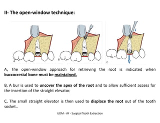UDM - AY - Surgical Tooth Extraction
II- The open-window technique:
A, The open-window approach for retrieving the root is indicated when
buccocrestal bone must be maintained.
B, A bur is used to uncover the apex of the root and to allow sufficient access for
the insertion of the straight elevator.
C, The small straight elevator is then used to displace the root out of the tooth
socket..
 