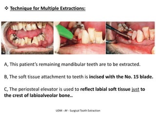 UDM - AY - Surgical Tooth Extraction
❖ Technique for Multiple Extractions:
A, This patient’s remaining mandibular teeth are to be extracted.
B, The soft tissue attachment to teeth is incised with the No. 15 blade.
C, The periosteal elevator is used to reflect labial soft tissue just to
the crest of labioalveolar bone..
 