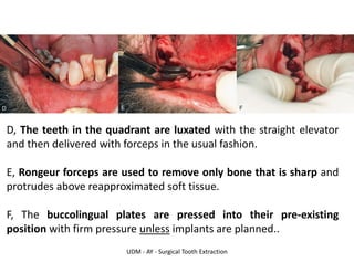 UDM - AY - Surgical Tooth Extraction
D, The teeth in the quadrant are luxated with the straight elevator
and then delivered with forceps in the usual fashion.
E, Rongeur forceps are used to remove only bone that is sharp and
protrudes above reapproximated soft tissue.
F, The buccolingual plates are pressed into their pre-existing
position with firm pressure unless implants are planned..
 