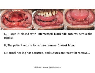 UDM - AY - Surgical Tooth Extraction
G, Tissue is closed with interrupted black silk sutures across the
papilla.
H, The patient returns for suture removal 1 week later.
I, Normal healing has occurred, and sutures are ready for removal..
 