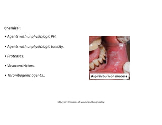 UDM - AY - Principles of wound and bone healing
Chemical:
• Agents with unphysiologic PH.
• Agents with unphysiologic tonicity.
• Proteases.
• Vasoconstrictors.
• Thrombogenic agents..
 