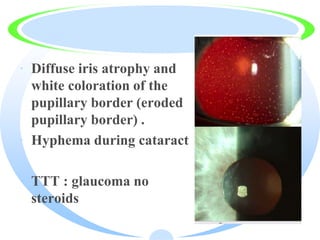 · Diffuse iris atrophy and
white coloration of the
pupillary border (eroded
pupillary border) .
· Hyphema during cataract
· TTT : glaucoma no
steroids
 