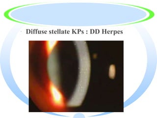 · Diffuse stellate KPs : DD Herpes
 