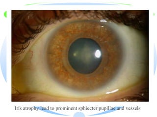 Iris atrophy lead to prominent sphiecter pupillae and vessels
 