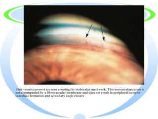 · Fine vessels (arrows) are seen crossing the trabecular meshwork. This neovascularization is
not accompanied by a fibrovascular membrane and does not result in peripheral anterior
synechiae formation and secondary angle closure
 