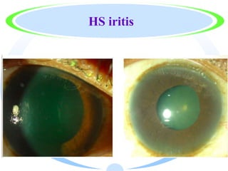 HS iritis
 