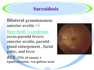 Sarcoidosis
· Bilateral granulomatous
anterior uveitis √√
· Heer fordt ’s syndrome
(uveo-parotid fever):
anterior uveitis, parotid
gland enlargement , facial
palsy, and fever
· ACE (75% of cases) +
hypercalcemia, +ve galium scan
 