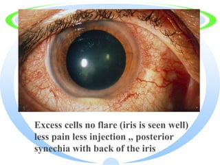 · Excess cells no flare (iris is seen well)
less pain less injection ,, posterior
synechia with back of the iris
 
