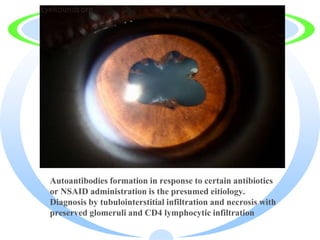 · Autoantibodies formation in response to certain antibiotics
or NSAID administration is the presumed eitiology.
Diagnosis by tubulointerstitial infiltration and necrosis with
preserved glomeruli and CD4 lymphocytic infiltration
 