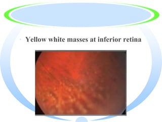 · Yellow white masses at inferior retina
 