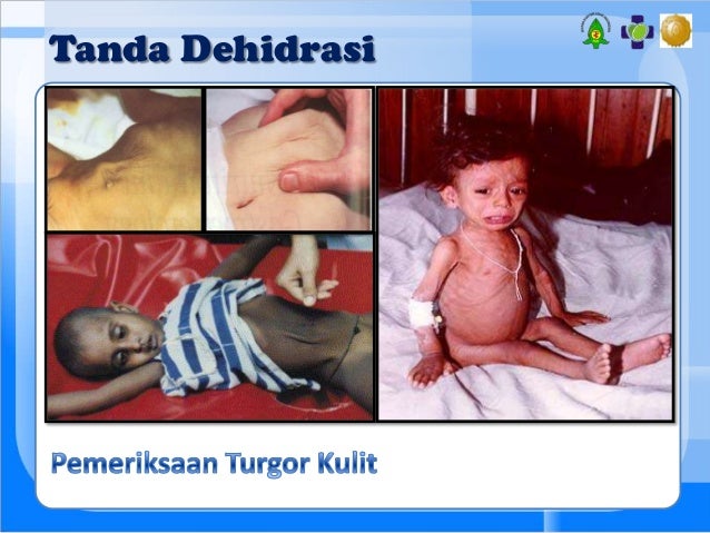 Simpo pkb kegawatan pada diare dengan dehidrasi berat