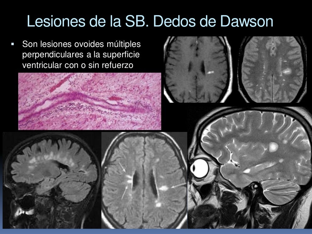 Imagenes en la esclerosis multiple. Simposio centroamerican de EM