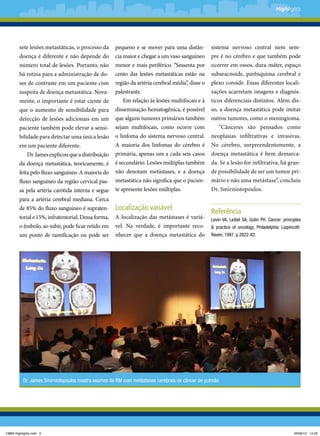 Highlights

sete lesões metastáticas, o processo da

fluxo sanguíneo da região cervical pas-

pequeno e se mover para uma distância maior e chegar a um vaso sanguíneo
menor e mais periférico. “Sessenta por
cento das lesões metastáticas estão na
região da artéria cerebral média”, disse o
palestrante.
Em relação às lesões multifocais e à
disseminação hematogênica, é possível
que alguns tumores primários também
sejam multifocais, como ocorre com
o linfoma do sistema nervoso central.
A maioria dos linfomas do cérebro é
primária, apenas um a cada seis casos
é secundário. Lesões múltiplas também
não denotam metástases, e a doença
metastática não significa que o pacien-

sa pela artéria carótida interna e segue

te apresente lesões múltiplas.

doença é diferente e não depende do
número total de lesões. Portanto, não
há rotina para a administração de doses de contraste em um paciente com
suspeita de doença metastática. Novamente, o importante é estar ciente de
que o aumento de sensibilidade para
detecção de lesões adicionais em um
paciente também pode elevar a sensibilidade para detectar uma única lesão
em um paciente diferente.
Dr. James explicou que a distribuição
da doença metastática, teoricamente, é
feita pelo fluxo sanguíneo. A maioria do

para a artéria cerebral mediana. Cerca
de 85% do fluxo sanguíneo é supraten-

Localização variável

torial e 15%, infratentorial. Dessa forma,

A localização das metástases é variá­
vel. Na verdade, é importante reconhecer que a doença metastática do

o êmbolo, ao subir, pode ficar retido em
um ponto de ramificação ou pode ser

sistema nervoso central nem sempre é no cérebro e que também pode
ocorrer em ossos, dura-máter, espaço
subaracnoide, parênquima cerebral e
plexo coroide. Essas diferentes localizações acarretam imagens e diagnósticos diferenciais distintos. Além disso, a doença metastática pode imitar
outros tumores, como o meningioma.
“Cânceres são pensados como
neo­lasias infiltrativas e invasivas.
p
No cérebro, surpreendentemente, a
doença metastática é bem demarcada. Se a lesão for infiltrativa, há grande possibilidade de ser um tumor primário e não uma metástase”, concluiu
Dr. Smirniotopoulos.

Referência
Levin VA, Leibel SA, Gutin PH. Cancer: principles
& practice of oncology. Philadelphia: LippincottRaven, 1997. p.2022-82.

Dr. James Smirniotopoulos mostra exames de RM com metástases cerebrais de câncer de pulmão.

13869 Highlights.indd 3

06/06/12 14:26

 