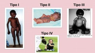 Tipo I Tipo II Tipo III 
Tipo IV 
 