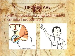 TIPOS DE AVE AVE – I: QUANDO UM VASO QUE IRRIGA O CÉREBRO É BLOQUEADO. 