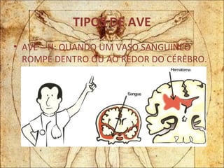 TIPOS DE AVE AVE – H: QUANDO UM VASO SANGUINEO ROMPE DENTRO OU AO REDOR DO CÉREBRO. 