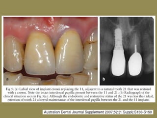 Simpósio inter relação periodontia-cirurgia-prótese evidências científicas embasando a prática clínica na implantodontia