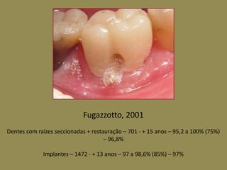 Fugazzotto, 2001
Dentes com raízes seccionadas + restauração – 701 - + 15 anos – 95,2 a 100% (75%)
– 96,8%
Implantes – 1472 - + 13 anos – 97 a 98,6% (85%) – 97%
 